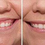 مهم‌ترین علت سیاه شدن لثه (قسمت3) | بهترین دندانپزشک اصفهان