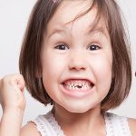 علت کج درآمدن دندان دائمی کودک | بهترین دندانپزشک اصفهان