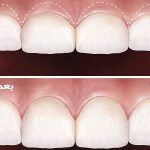 جراحی افزایش طول تاج دندان | بهترین دندانپزشک اصفهان