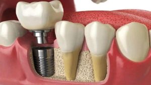 خطرات و عوارض ایمپلنت دندان در بارداری | بهترین دندانپزشک اصفهان