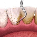 اصلی ترین مزایا و معایب استفاده از بروساژ دندان | بهترین دندانپزشک اصفهان