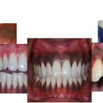 روش‌های درمان سیاه شدن لثه | بهترین دندانپزشک اصفهان