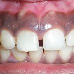 روش پیشگیری و درمان‌های خانگی سیاه شدن لثه | بهترین دندانپزشک اصفهان