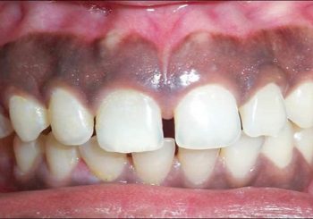 سیاه شدن لثه نشانه چیست؟