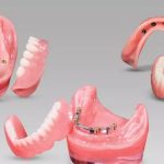 انواع اوردنچر بر پایه ایمپلنت چیست؟ | بهترین دندانپزشک اصفهان