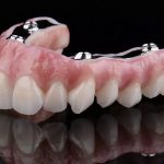 فواید و مشکلات اوردنچر نسبت به پروتزهای دیگر | بهترین دندانپزشک اصفهان