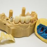 انواع روش های قالب گیری ایمپلنت دندان | بهترین دندانپزشک اصفهان