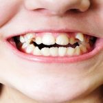روش های صاف کردن دندان کج (قسمت اول) | بهترین دندانپزشک اصفهان