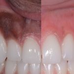 مهم‌ترین علت سیاه شدن لثه (قسمت2) | بهترین دندانپزشک اصفهان