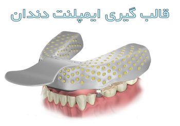 قالب گیری ایمپلنت چیست؟