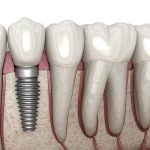 آنچه از ایمپلنت فوری باید بدانید | بهترین دندانپزشک اصفهان