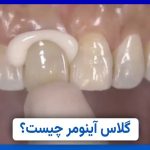 گلاس آینومر چیست؟ | بهترین دندانپزشک اصفهان