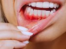 ارتباط بین بیماری‌های لثه و بیماری‌های سیستمیک