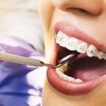 باورهای نادرست در مورد ارتودنسی | بهترین دندانپزشک اصفهان