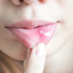 انواع آفت دهانی | بهترین دندانپزشک اصفهان