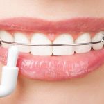 روش های مختلف ارتودنسی متحرک | بهترین دندانپزشک اصفهان
