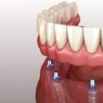 اوردنچر ایمپلنت چیست؟ | بهترین دندانپزشک اصفهان