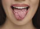 بررسی علل، مدیریت و درمان خشکی دهان