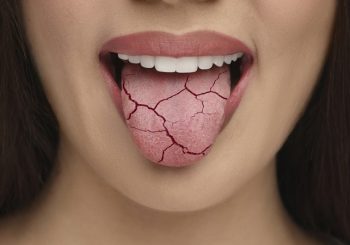 بررسی علل، مدیریت و درمان خشکی دهان