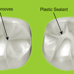 بررسی موارد استفاده از فیشورسیلانت | بهترین دندانپزشک اصفهان