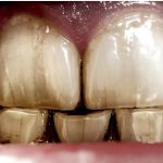 ترکهای مویی دندان یا کریز لاینها