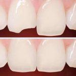 روش های ترمیم دندان های شکسته | بهترین دندانپزشک اصفهان