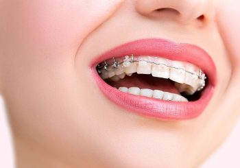 تفاوت کاربردهای ارتودنسی سرامیکی و فلزی