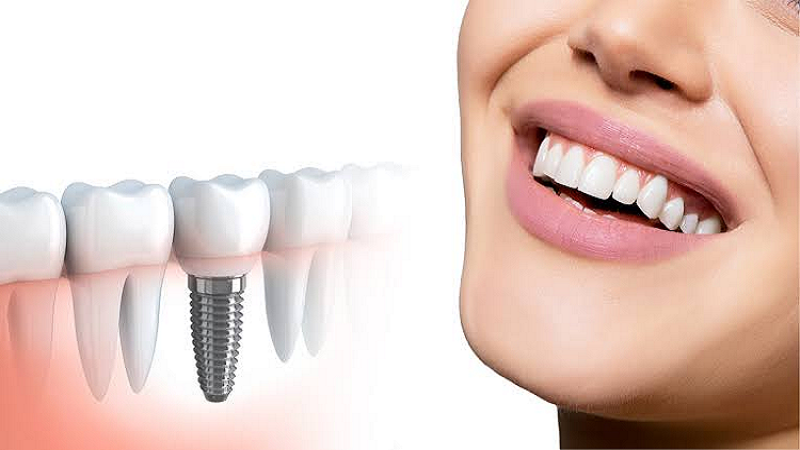 ایمپلنت فوری چیست؟ | بهترین دندانپزشک اصفهان