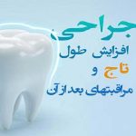مراقبت های بعد از عمل افزایش طول تاج دندان | بهترین دندانپزشک اصفهان