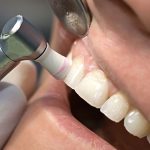 انواع بروساژ دندان | بهترین دندانپزشک اصفهان