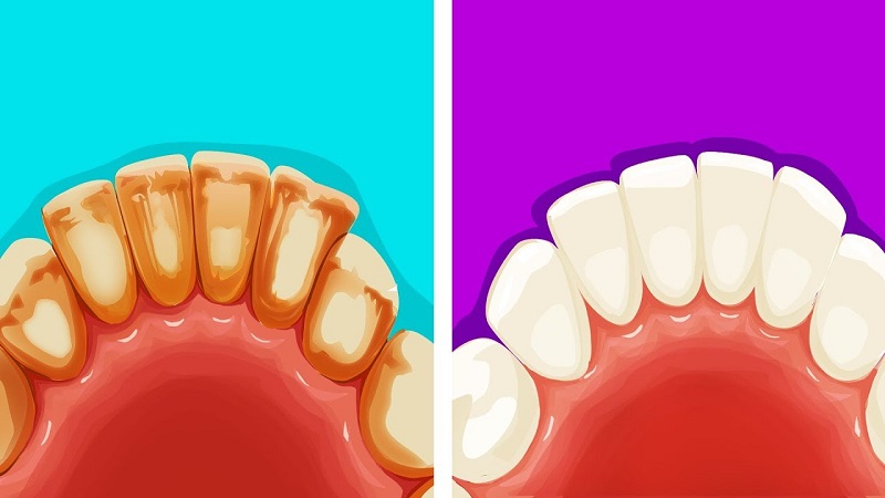 جرمگیری دندان | بهترین دندانپزشک اصفهان