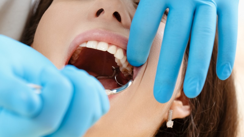 دلایل و نحوه کشیدن دندان عقل | بهترین دندانپزشک اصفهان