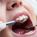 دلایل پوسیدگی دندان بعد از کامپوزیت | بهترین دندانپزشک اصفهان | دکتر حمید رضویان