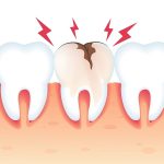 راه های توقف پوسیدگی دندان | بهترین دندانپزشک اصفهان | دکتر سید حمید رضویان