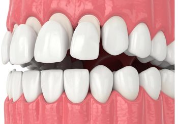 راهنمای جامع انتخاب بین لمینت و کامپوزیت ونیر