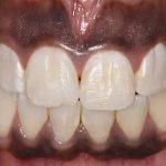 مهم‌ترین علت سیاه شدن لثه (قسمت1) | بهترین دندانپزشک اصفهان