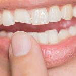 منظور از شکستگی و آسیب های جزئی دندان چیست؟ | بهترین دندانپزشک اصفهان