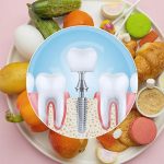 عادات غذایی پس از ایمپلنت دندان برای پایداری و طول عمر | بهترین دندانپزشک اصفهان | دکتر سید حمید رضویان