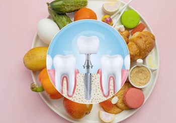 عادات غذایی پس از ایمپلنت دندان برای پایداری و طول عمر