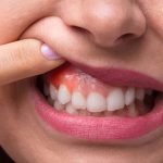 علل و علائم بیماری لثه | بهترین دندانپزشک اصفهان