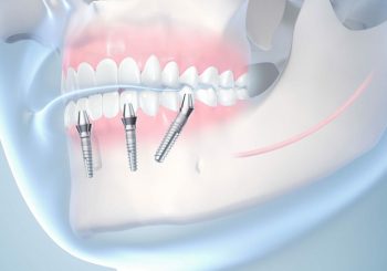 عوامل تعیین کننده بهترین زمان کاشت ایمپلنت