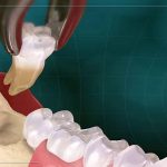 مراحل انجام جراحی کشیدن دندان عقل | بهترین دندانپزشک اصفهان