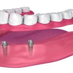 مراحل اوردنچر دندان چیست؟ | بهترین دندانپزشک اصفهان