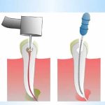 مراحل درمان ریشه دندان | بهترین دندانپزشک اصفهان |