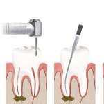 مراحل عصب کشی دندان | بهترین دندانپزشک اصفهان | دکتر سید حمید رضویان