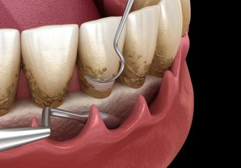 مزایا و عوارض انجام کورتاژ لثه