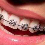 مزایا و معایب انواع براکت ارتودنسی ثابت | بهترین دندانپزشک اصفهان