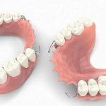 مقایسه ایمپلنت با دندان مصنوعی متحرک | بهترین دندانپزشک اصفهان