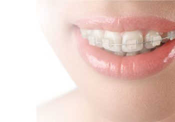 مقایسه مزایا و معایب ارتودنسی سرامیکی با فلزی