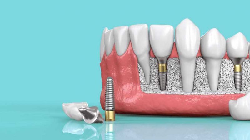 موارد استفاده و منع ایمپلنت دندان | بهترین دندانپزشک اصفهان